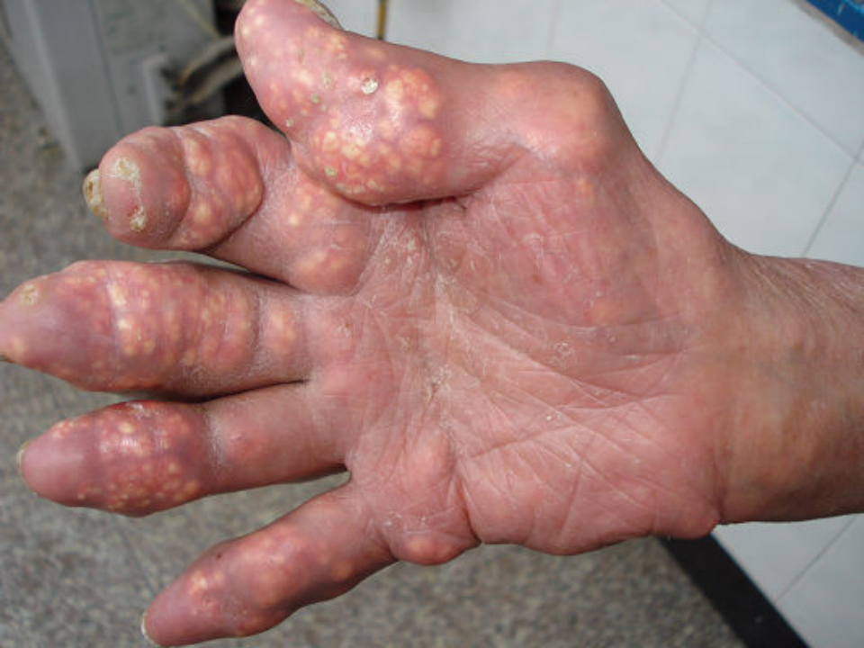 风湿免疫科-痛风.ppt 第1页