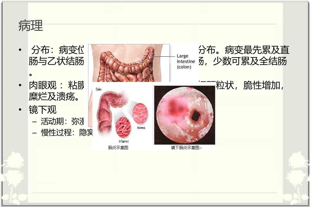 消化内科-溃疡性结肠炎.ppt 第3页