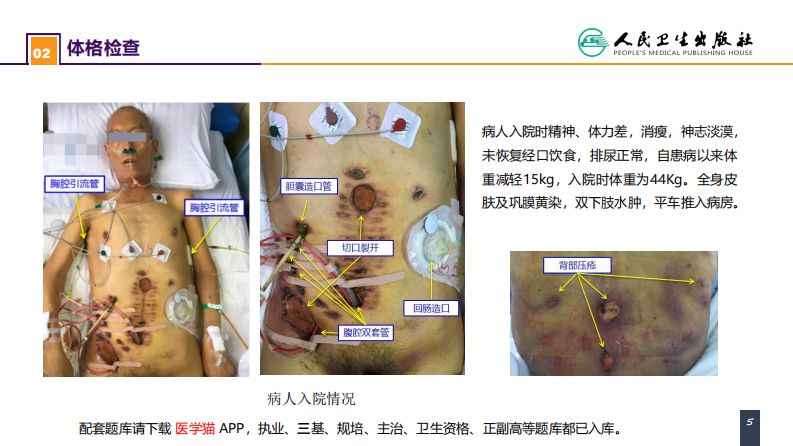 第十一章 案例分析-肠瘘、腹腔感染合并脓毒症.pdf 第5页