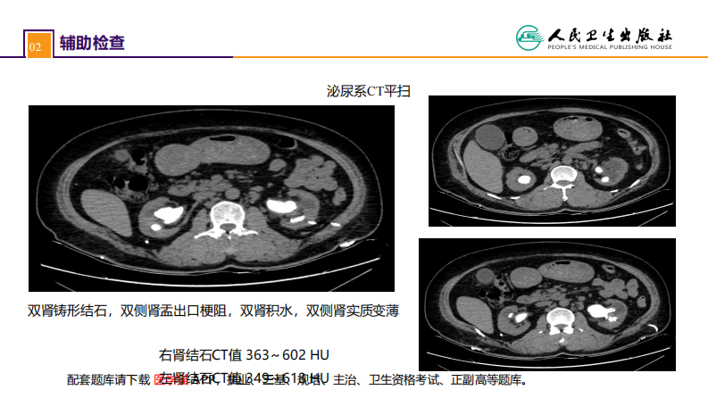 第五十二章 案例分析-双肾结石并慢性肾功能不全.pdf 第5页