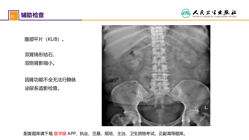 第五十二章 案例分析-双肾结石并慢性肾功能不全.pdf 第4页