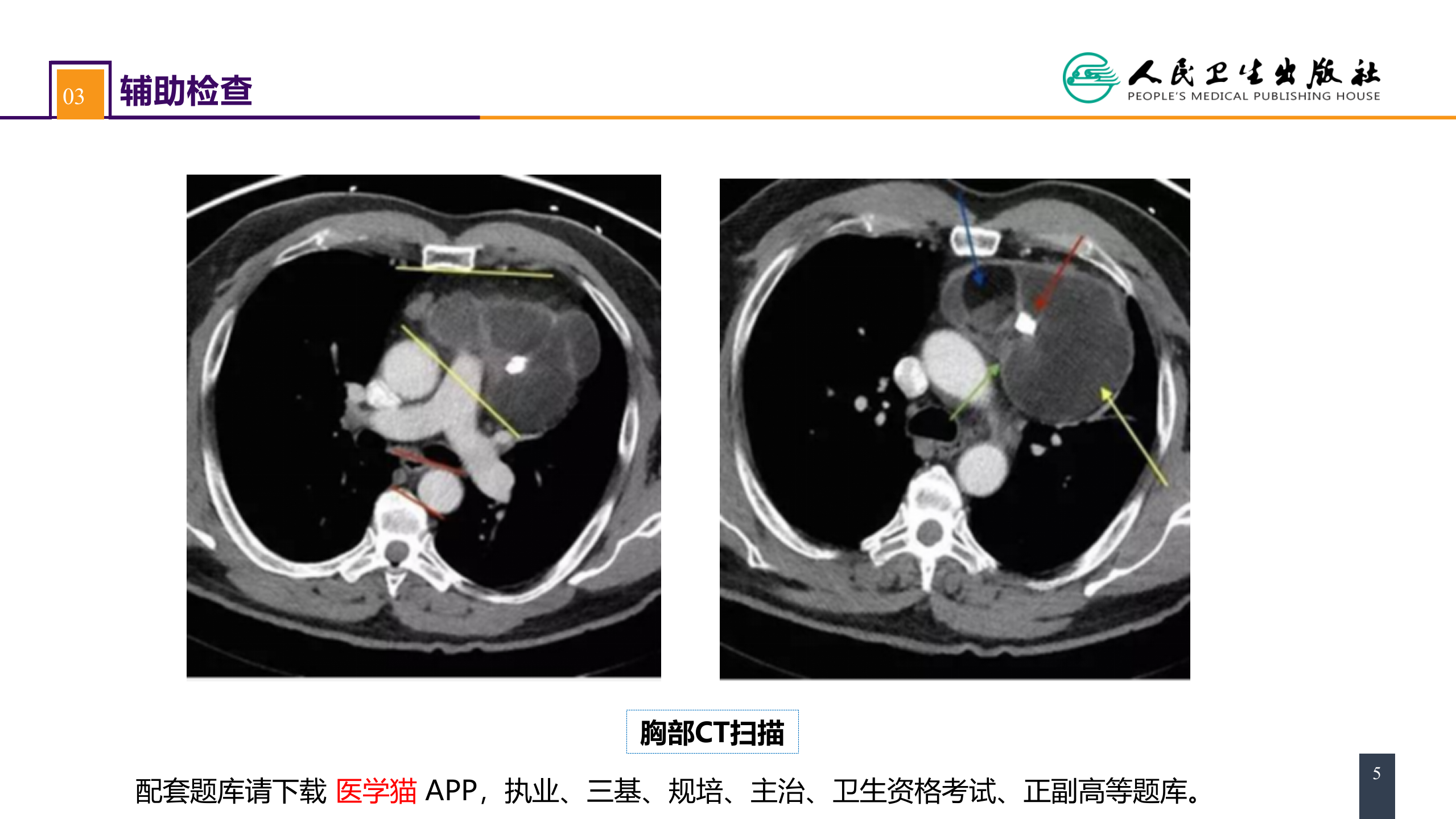 第二十八章 原发性纵隔肿瘤 案例分析-纵隔畸胎瘤.pptx 第5页