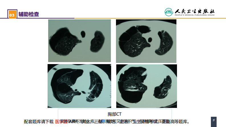 第二十六章 肺部疾病 案例分析-肺大疱合并自发性气胸.pdf 第5页