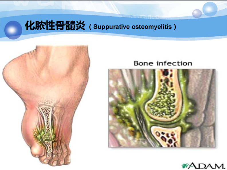 骨科-骨与关节化脓性感染、结核.pdf 第4页