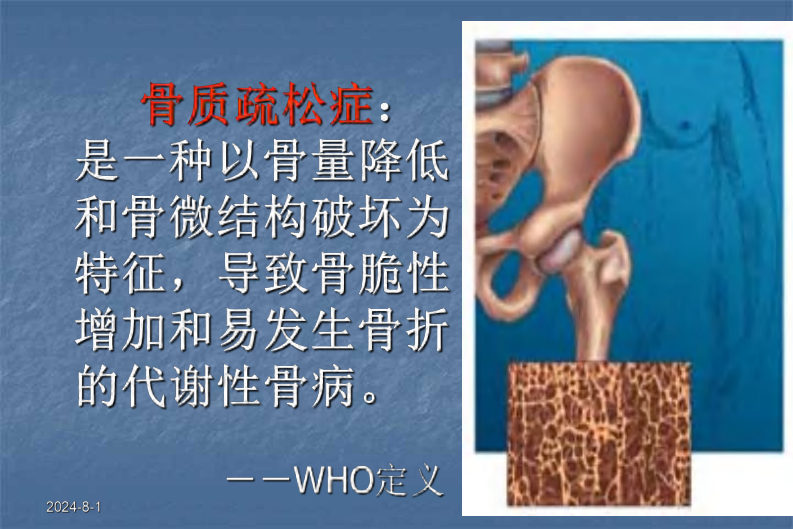 骨科-骨质疏松症ppt.pdf 第3页