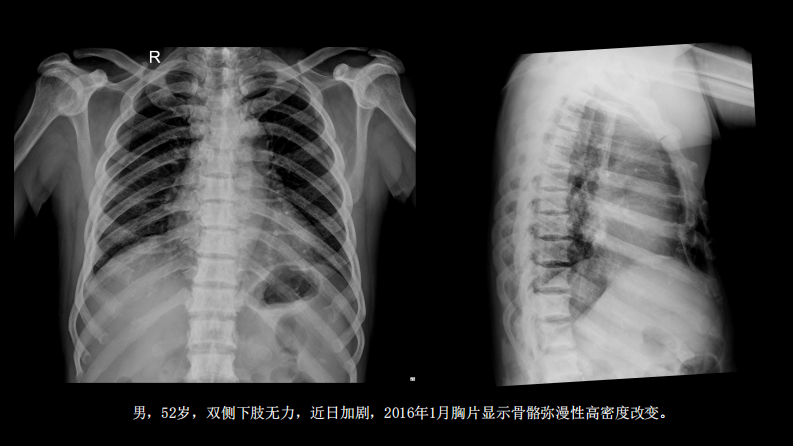 氟骨症的X线CT及MR影像及解读.pdf 第2页