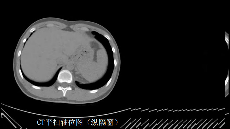 这样的肺隔离症：影像共享.pdf 第4页