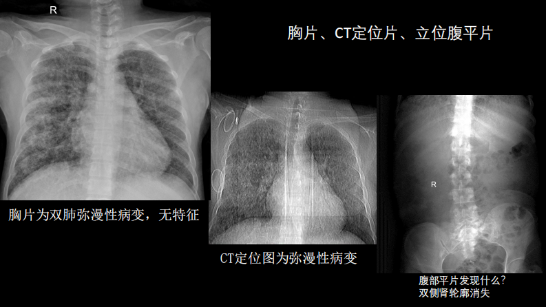 肺淋巴管肌瘤病合并双侧巨大肾血管平滑肌脂肪瘤(X线、CT、MR).pdf 第4页