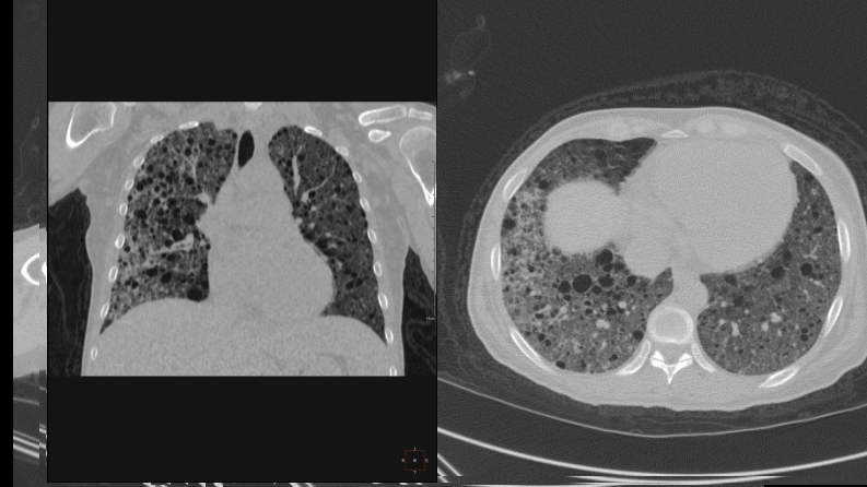 肺淋巴管肌瘤病合并双侧巨大肾血管平滑肌脂肪瘤(X线、CT、MR).pdf 第5页