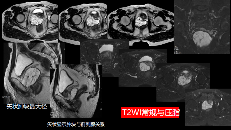 异位前列腺误诊为肿瘤.pdf 第4页