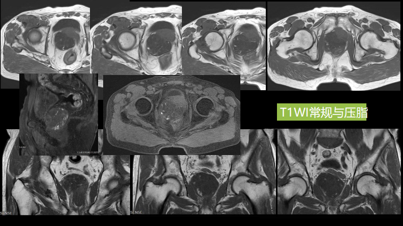 异位前列腺误诊为肿瘤.pdf 第5页