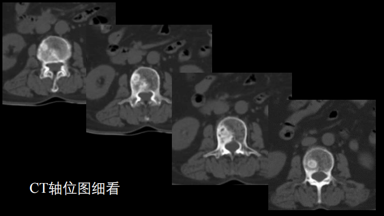 一例椎体的局灶病变影像表现分析暨影像诊断扩展.pdf 第5页