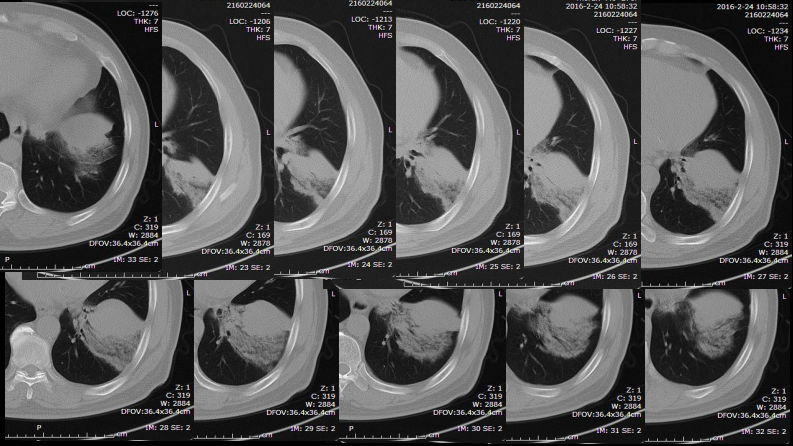 一例肺粘液腺癌综合影像及病理学回顾.pdf 第4页