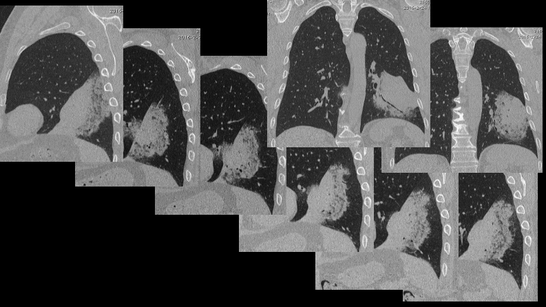 一例肺粘液腺癌综合影像及病理学回顾.pdf 第5页