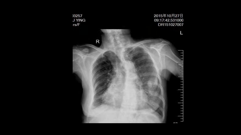 肺部空洞性病变CT与MRI.pdf 第4页