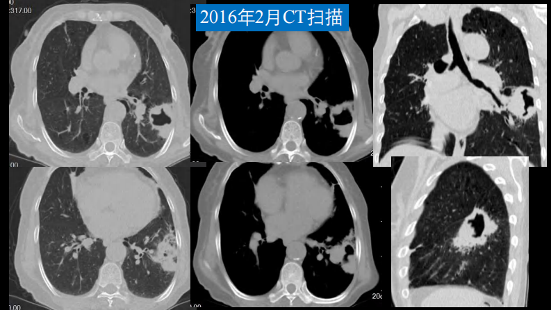 肺部空洞性病变CT与MRI.pdf 第5页