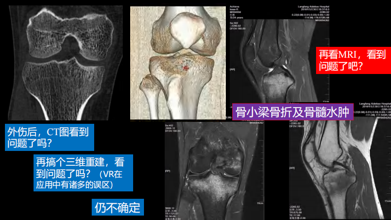 膝关节损伤：MR图像解读.pdf 第5页