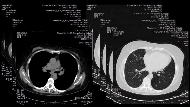胸部结节病综合影像学交流.pdf 第4页