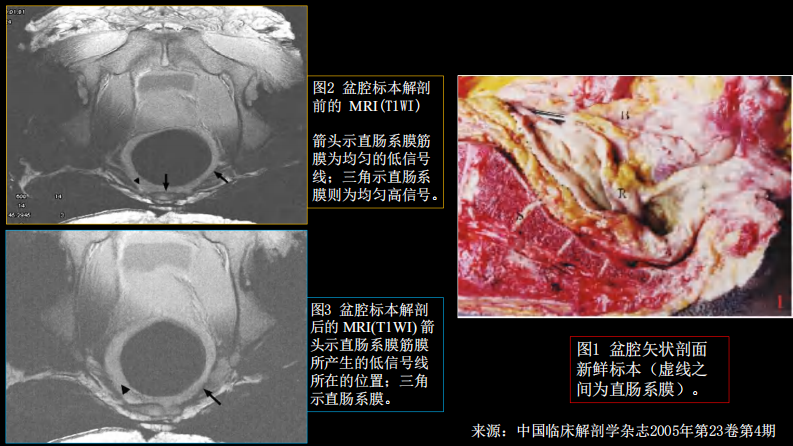 直肠癌：MRI与临床.pdf 第5页