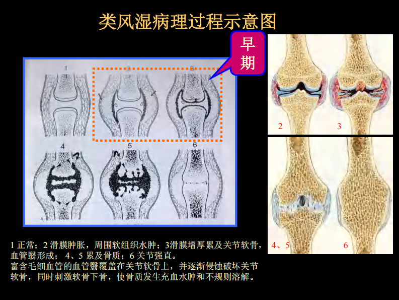 类风湿性、强直性脊柱炎的影像学诊断.pdf 第5页