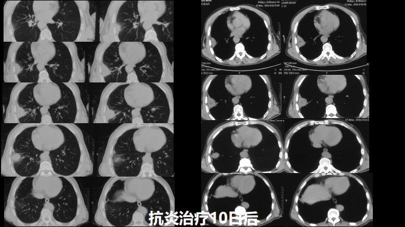 肺部肿块有效的影像检查选择.pdf 第5页