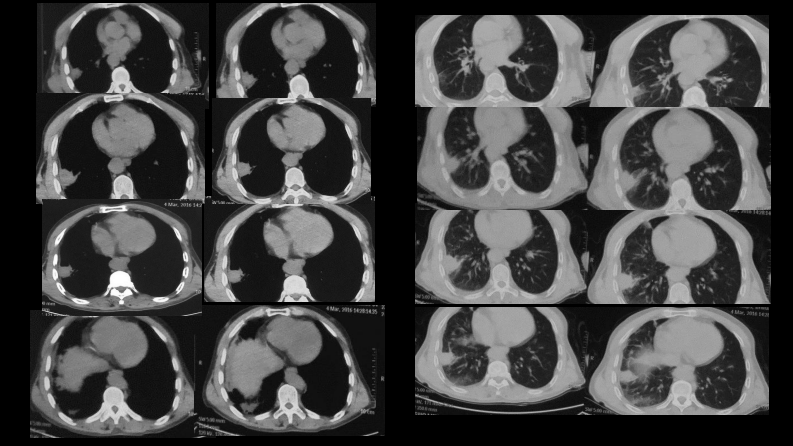 肺部肿块有效的影像检查选择.pdf 第4页