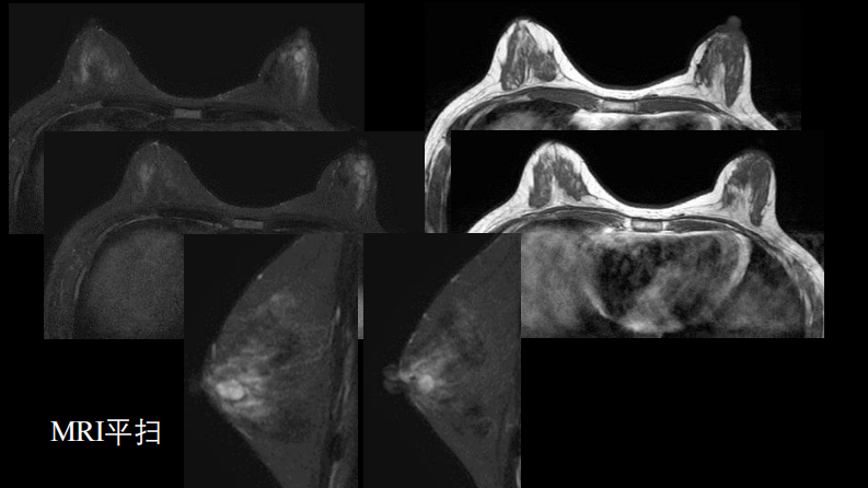 乳腺囊性肿块MRI：鉴别不困难.pdf 第5页