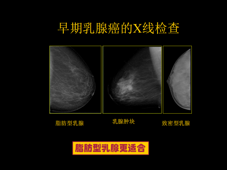 乳腺癌早期影像检查.pdf 第5页