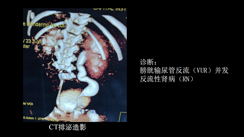影像科容易忽略的病：膀胱输尿管反流.pdf 第5页