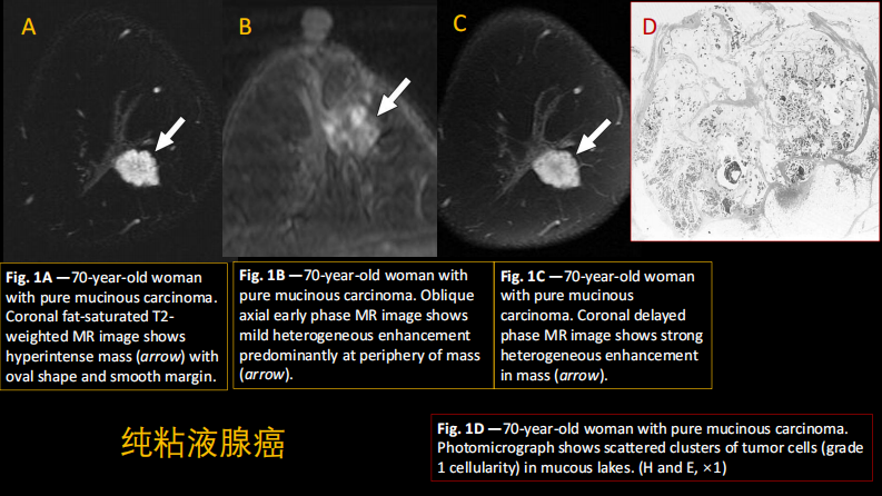 乳腺粘液腺癌MR与病理特点.pdf 第2页
