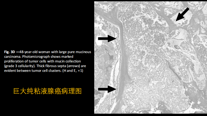 乳腺粘液腺癌MR与病理特点.pdf 第5页