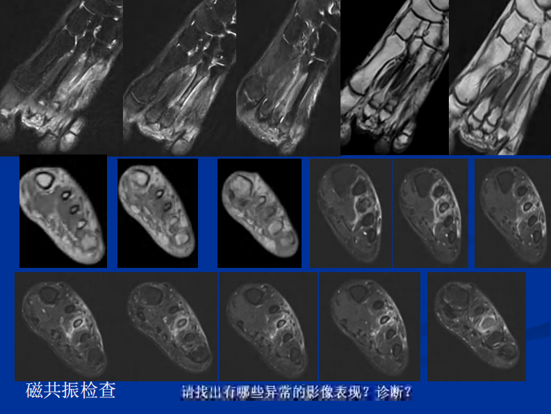 影像学病例读片-应力性骨折.pdf 第5页