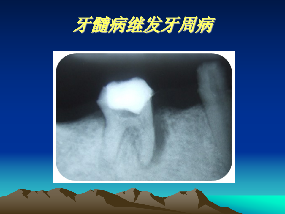 牙周病1.ppt 第4页