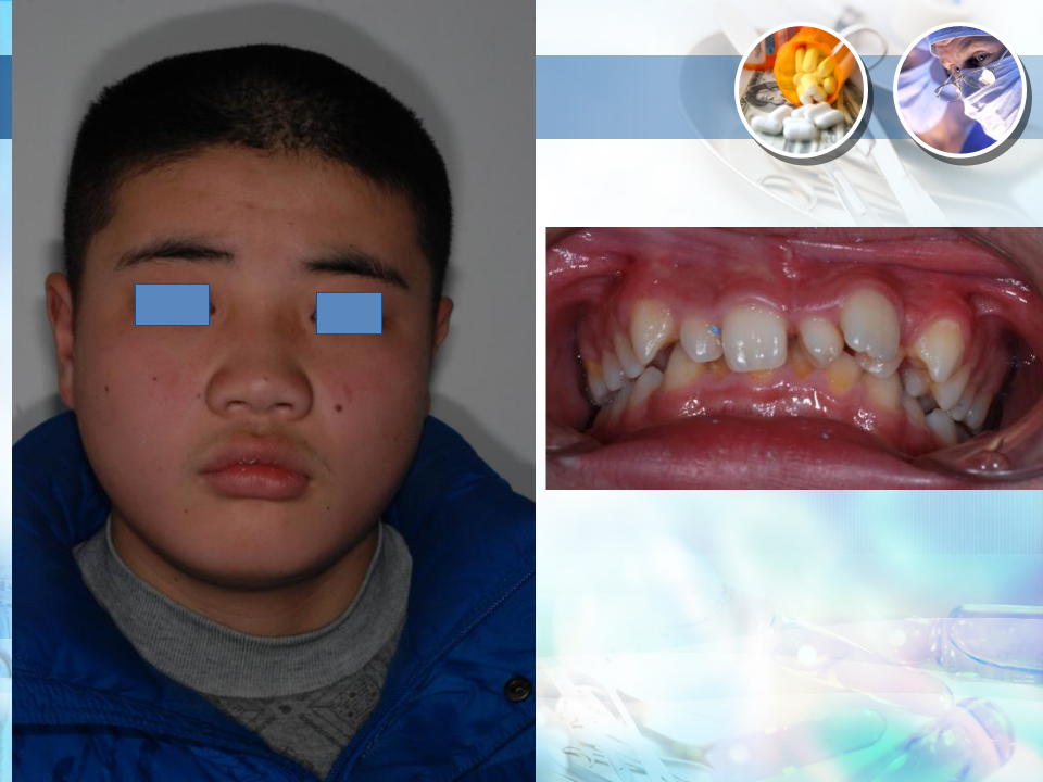 总义齿(四） 排牙.ppt 第5页