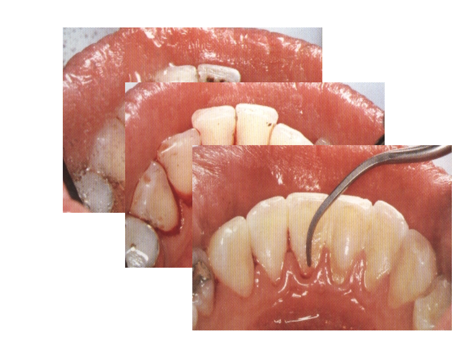 根 面 平 整 术 2011.2.16.pptx 第4页