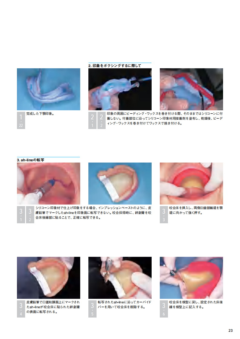 采用硅橡胶印模材料的简便的无牙颌功能印模.pdf 第4页