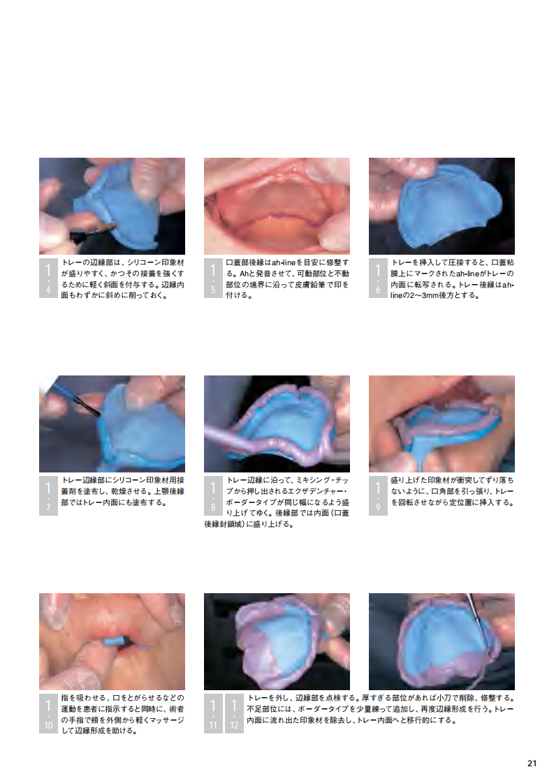 采用硅橡胶印模材料的简便的无牙颌功能印模.pdf 第2页