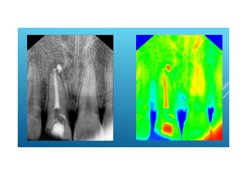 现代根管治疗的临床步骤最最最终版.pdf 第5页