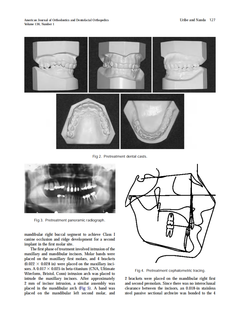 Uribe_Intramaxillary-and-intermaxillary-absolute-anchorage-with-an-endosseous-dental-implant-and-rare-earth-magnets_2009.pdf 第4页
