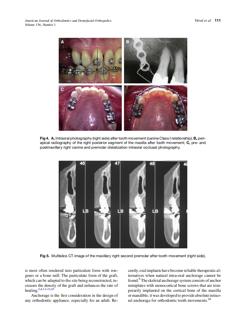 Vitral_Orthodontic-distalization-with-rigid-plate-fixation-for-anchorage-after-bone-grafting-and-maxillary-sinus-lifting_2009.pdf 第3页
