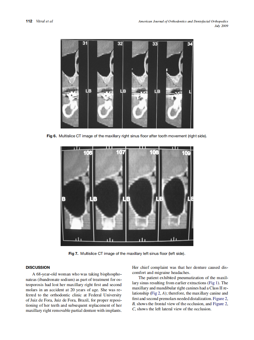Vitral_Orthodontic-distalization-with-rigid-plate-fixation-for-anchorage-after-bone-grafting-and-maxillary-sinus-lifting_2009.pdf 第4页