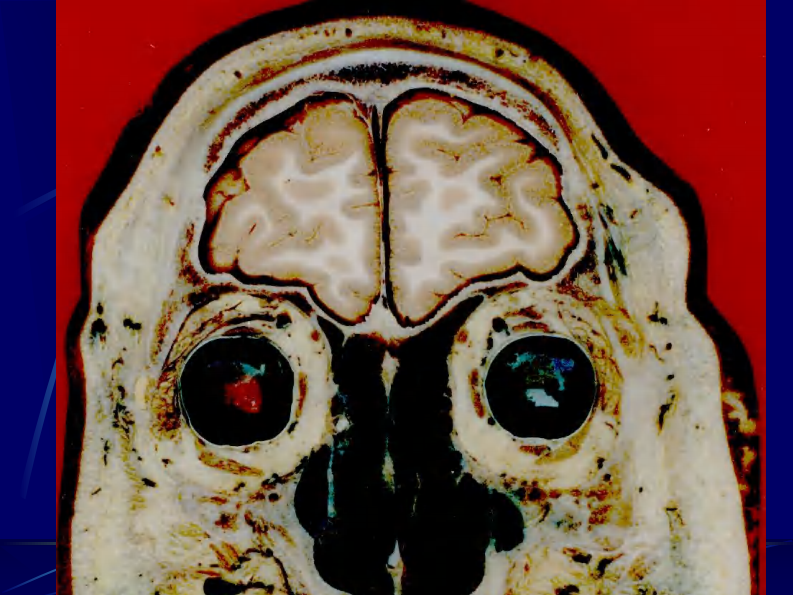 04 头部连续冠状断层解剖及MRI.pdf 第4页