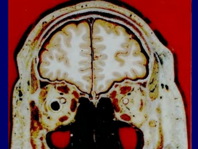 04 头部连续冠状断层解剖及MRI.pdf 第5页