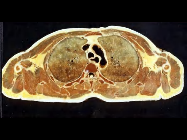 07 纵隔连续横断层解剖及CT.pdf 第5页