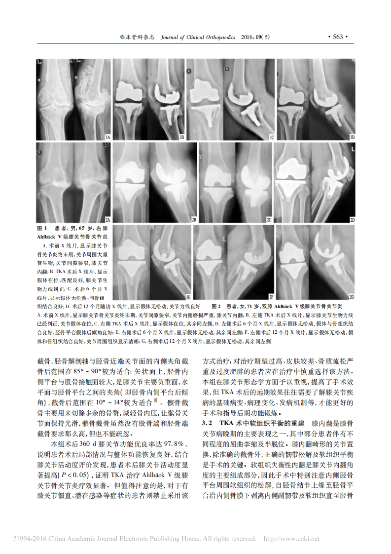 人工全膝关节置换治疗膝关节骨关节炎_孙效虎.pdf 第3页