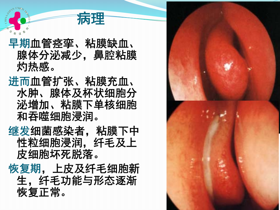 2011级临床口腔-慢性鼻炎变应性鼻炎鼻息肉-教室.ppt 第4页
