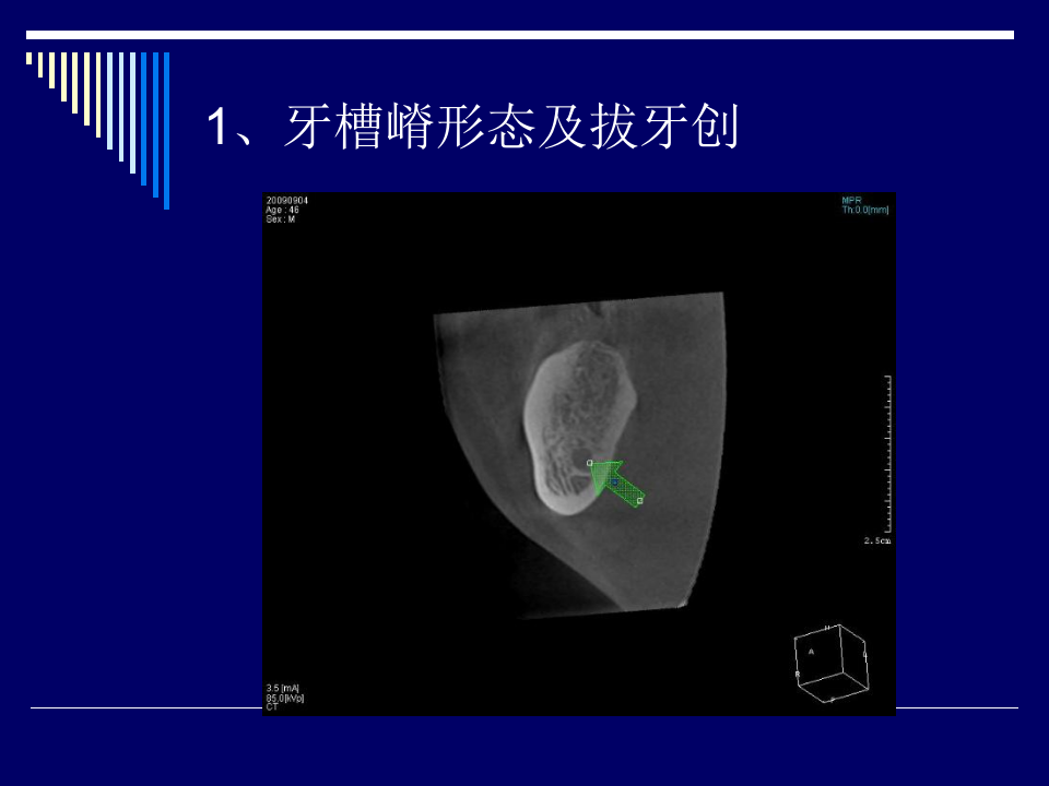 口腔3D影像在口腔种植中的应用.ppt 第4页