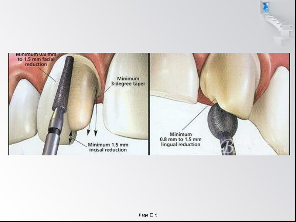 全瓷牙备牙方法.ppt 第5页