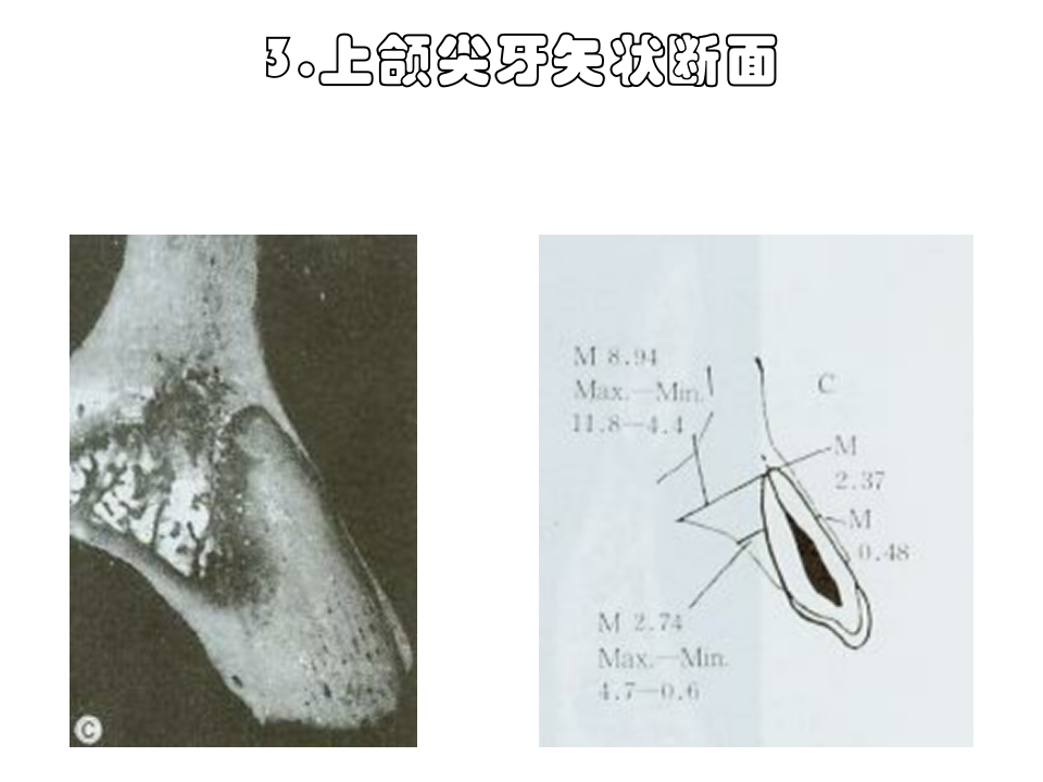 牙槽嵴与牙槽窝骨性解剖.ppt 第5页