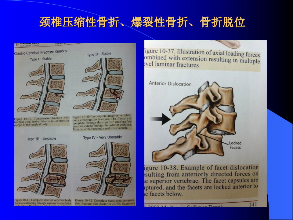 脊柱骨折-中日联谊医院.ppt 第5页